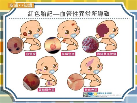 嬰兒 胎記|認識胎記的種類與治療照顧